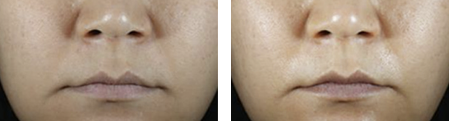 Resultados do tratamento na face